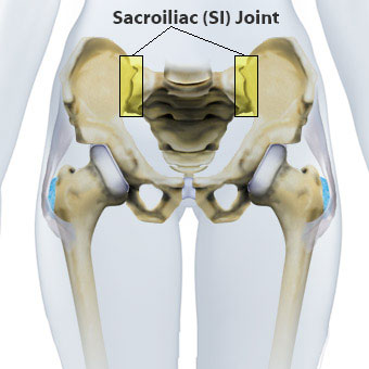 Sacroiliacalis ízület disfunkciója okozta derék és lábfájdalom, Sacroiliac artrosis kezelés