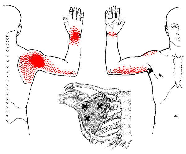 deformált artrózis a térdízület kezelése 3 fokkal